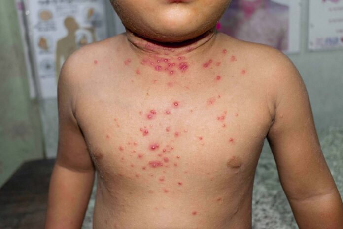 Monkey pox and its impact on Children & Pregnant Moms