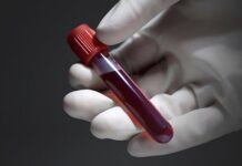 Widal Test: A Test To Confirm Typhoid Fever Widal Test, Typhoid Fever, Book Widal test,