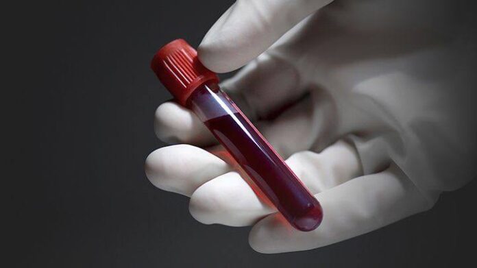 Widal Test, Typhoid Fever, Book Widal test,